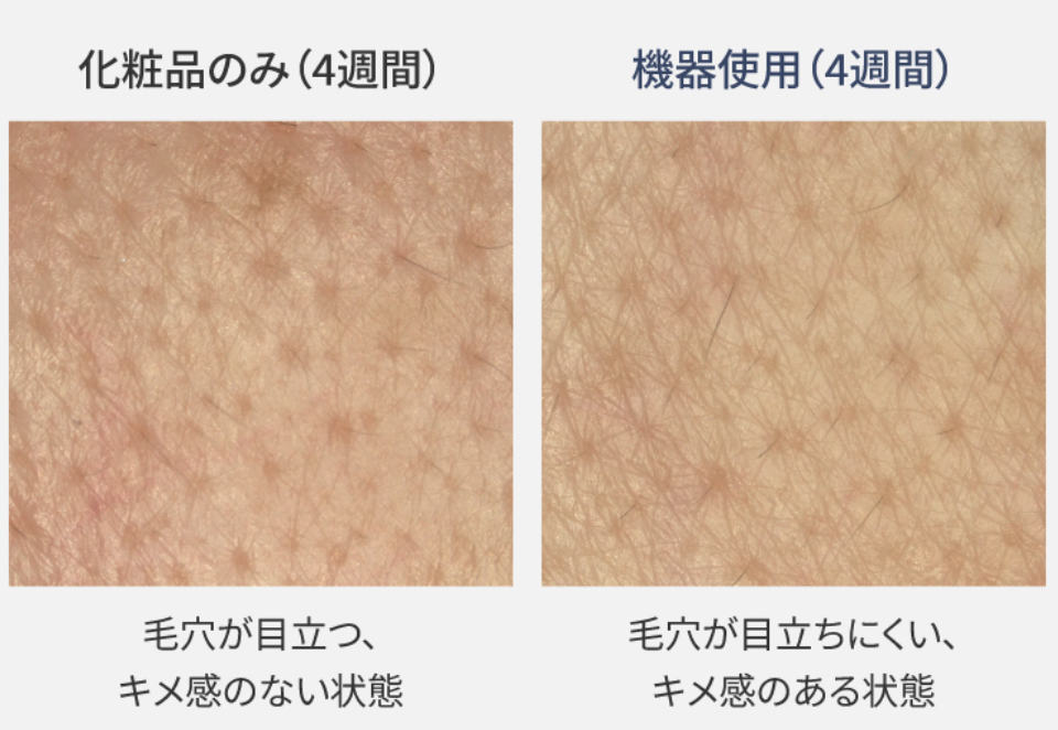 イオンブーストマルチEXを4週間使用したお肌の状態